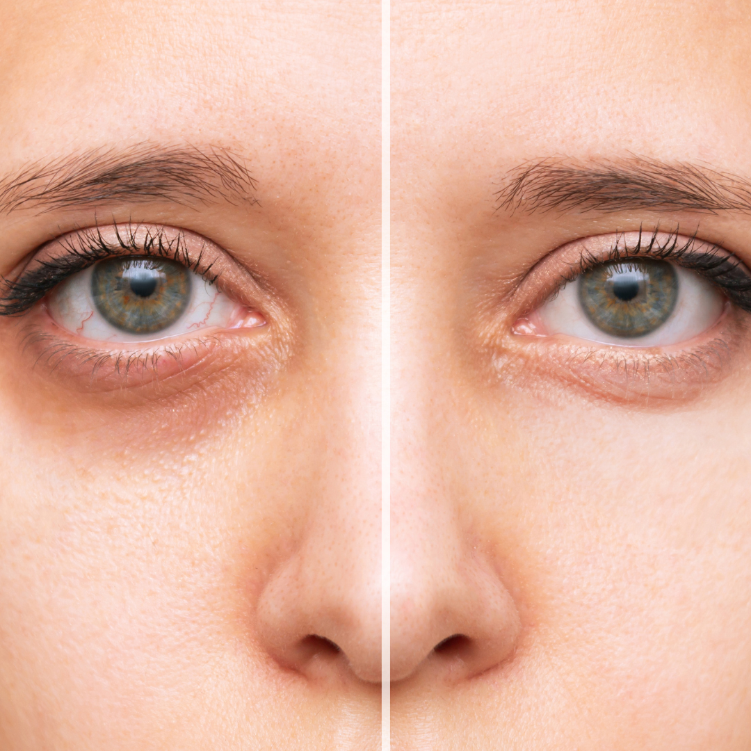 Woman showcases under-eye bag reduction; before-and-after skincare treatment reveals brighter eyes.
